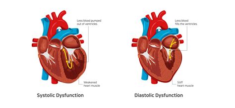 systolic vs diastolic heart failure.